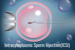 IVF