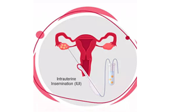 IUI